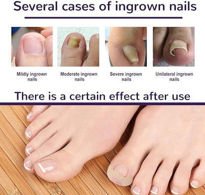 Ayak Tırnağı Düzeltme Bandı 50 Adet